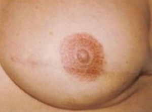 areola-tattooing-05