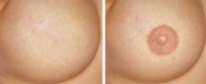 areola-tattooing-1