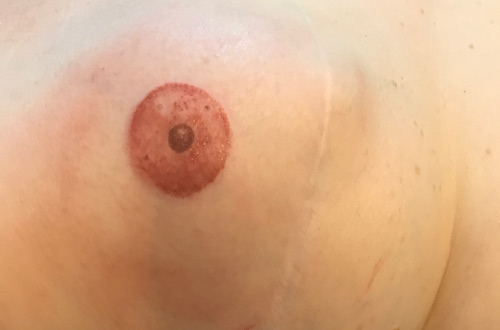 Areola tattooing